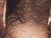 Monkeypox virus enters UAE, first case of monkeypox reported in the Gulf