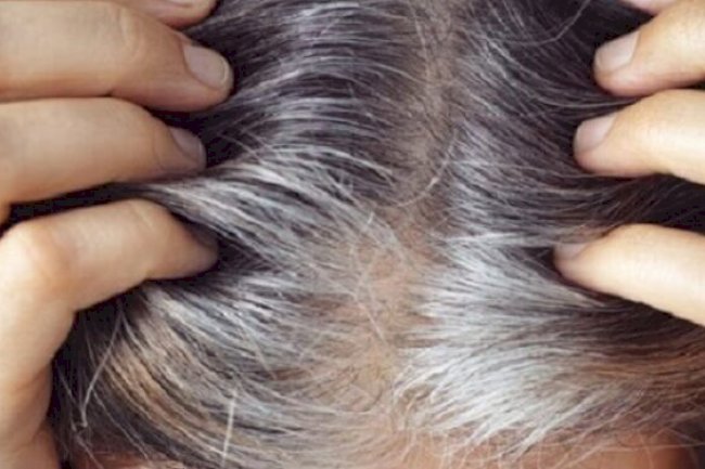 White hair tension! here is good homemade remedies