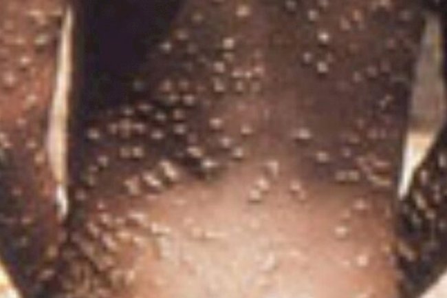 Monkeypox Rapidly Spreading: Union Ministry directed officers to be vigilant