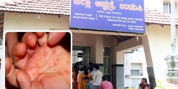 Tomato fever scare starts in India: 26 children detected in this state