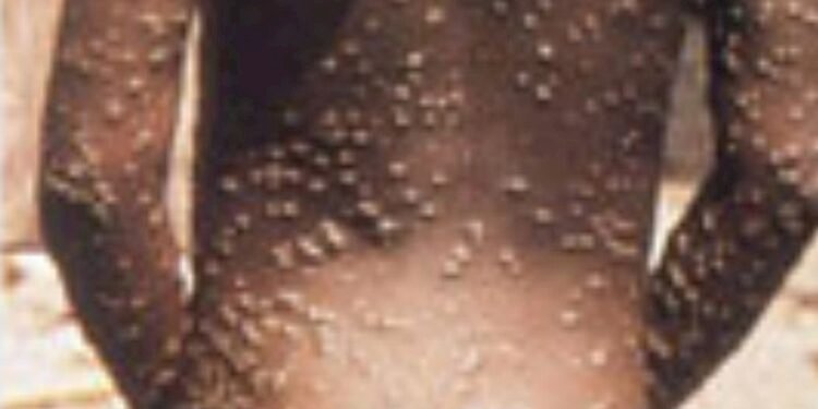 Monkeypox virus enters UAE, first case of monkeypox reported in the Gulf